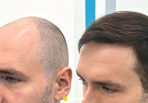 Przeszczep włosów FUE i DHI bez limitu graftów? FullFace Clinic proponuje nowy model