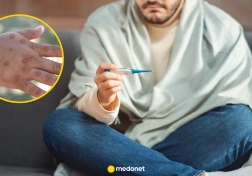 Liczba zakażeń mpox w Polsce rośnie. 