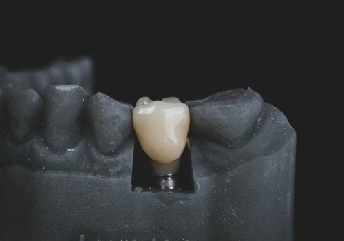 Implant zęba: ile trwa leczenie, ile wymaga wizyt i ile kosztuje