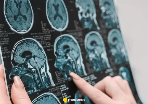 Choroba Alzheimera może zaczynać się poza mózgiem. Problem "leży" też w węzłach chłonnych