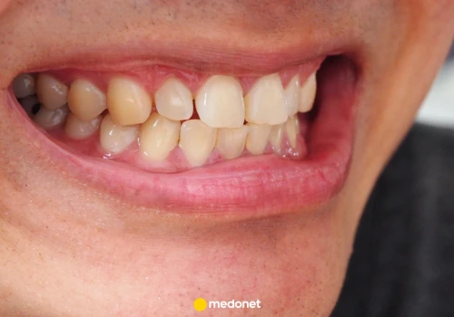 Jakie są domowe sposoby na żółte zęby? To radzi dentystka