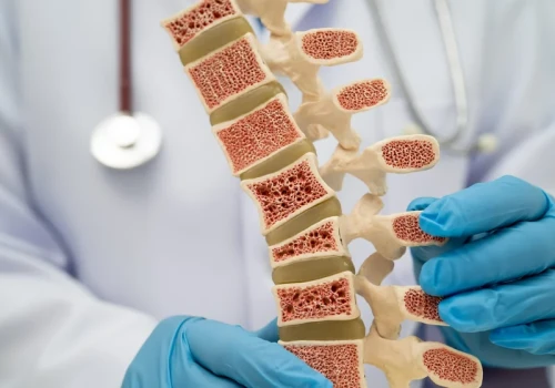 Osteoporoza to nie jest błaha choroba, potrafi zabić. Oto największe mity związane z osteoporozą