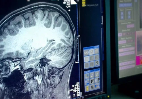 Skan mózgu odkrywa coś dziwnego. Chodzi o zaburzenia psychiczne
