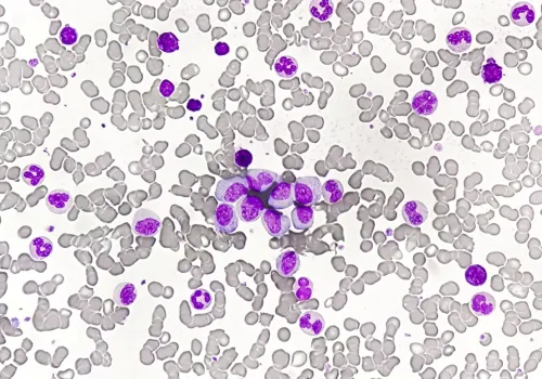 Przewlekła białaczka szpikowa – objawy, diagnostyka, leczenie, rokowania
