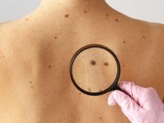 Czerniak – mały ale zabójczy nowotwór. Kiedy znamię trzeba pokazać dermatologowi?