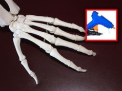 Lepsze przeszczepy kości? "Drukowanie" bezpośrednio na złamanie