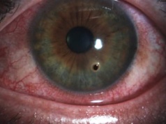 Miał opiłek w oku. Odmówili mu pomocy