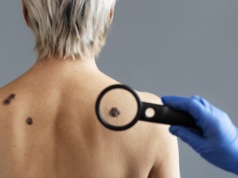 Zduńska Wola: profilaktyczne badania pod kątem czerniaka w centrum Karsznic. W planach kolejne takie akcje