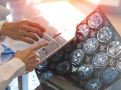 Naukowcy odkryli nowy podtyp stwardnienia rozsianego. W diagnozie może pomóc internetowe narzędzie