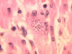 „Choroba całujących pluskiew” rozprzestrzenia się. Zarażonych 280 tys. osób?