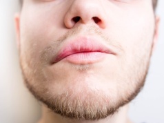 Obrzęk Quinckego - objawy, przyczyny i sposoby leczenia
