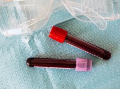 Pierwszy test krwi z 96% dokładnością rozpoznaje Zespół Przewlekłego Zmęczenia