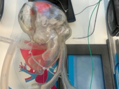 Medinice zrekrutowało wymaganą liczbę uczestników badania klinicznego CoolCryo