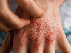 Ukryte obciążenia związane z egzemą: Jak stan zapalny, dieta i zdrowie psychiczne wpływają na atopowe zapalenie skóry