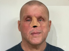 Mieszkaniec Białołęki potrzebuje pieniędzy na rekonstrukcję amputowanego nosa. "Zbyt późno zdiagnozowano nowotwór"