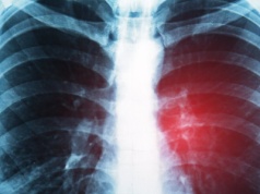 Rak drobnokomórkowy płuca to najbardziej agresywny nowotwór. Immunoterapia to szansa dla chorych