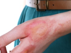 Ewolucyjna rola ognia. Oparzenia mogły ukształtować naszą odporność