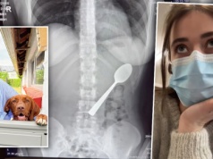 Przez przypadek połknęła łyżeczkę. Lekarze nie mogli uwierzyć w te zdjęcia