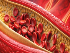 Miażdżyca jako proces zapalny