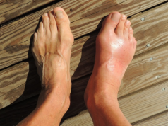 Sześć naturalnych sposobów na walkę z dną moczanową, „chorobą królów”