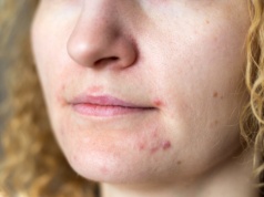 Herbaty, które działają od środka okiem ekspertki. Na trądzik, stany zapalne i skoki cukru.