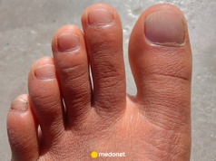 20 proc. ludzi ma palec grecki u stopy. Co to oznacza dla zdrowia? Mogą być problemy