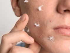 Wypryski, zaczerwienienie i zmiany bakteryjne znikną. Są z apteki bez recepty