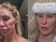 Brandi Glanville z żon "Żon Beverly Hills" ma problemy z twarzą po pęknięciu IMPLANTA PIERSI. Na leczenie wydała już ponad 700 tysięcy złotych