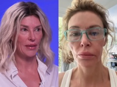 Gwiazda "Żon Beverly Hills" usłyszała diagnozę. Wydała krocie na lekarzy, gdy twarz jej się "rozpłynęła"