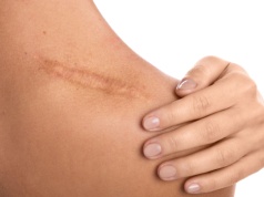 Skóra po przejściach, czyli jak skutecznie usuwać blizny i zgrubienia?