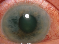 Jaskra kradnie wzrok 800 tysiącom Polaków. Rusza X edycja bezpłatnych badań okulistycznych