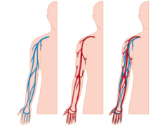 GUZKOWE ZAPALENIE TĘTNIC