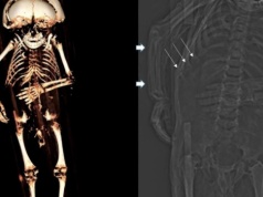 Bez słońca, zabawy, ruchu. Na zamkach i dworach hodowano kalekie dzieci