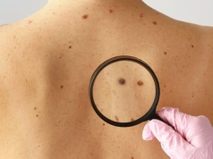 Onkolodzy alarmują: Coraz więcej zachorowań na czerniaka. Połowa przypadków wykrywana zbyt późno