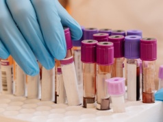 Zrobiony przed badaniem może wpłynąć na wyniki. Wrażliwy zwłaszcza cukier i hormony