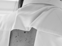 Łupież pstry - czy jest zaraźliwy?