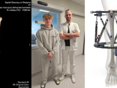 Ortopedzi ze Szpitala Dziecięcego w Olsztynie wykonają pierwszą na Warmii i Mazurach operację z zastosowaniem nowoczesnego zespolenia