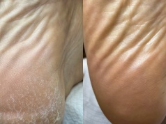 To najlepsza mikstura na popękane pięty. Rozwiąże problem w jedną noc