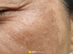 Ten nowy killer przebarwień maksymalnie rozjaśnia plamki. Efekt porcelanowej skóry