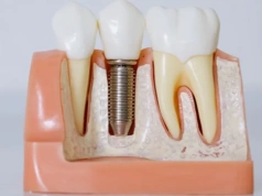 Implanty zębowe na Śląsku - co pacjent powinien wiedzieć przed podjęciem decyzji