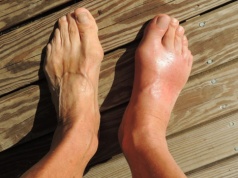 Ukryte czynniki wywołujące dnę moczanową: W jaki sposób dieta i styl życia nasilają ból – i jak temu zapobiegać