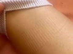 Widzisz takie ślady na nogach? To sygnał alarmowy