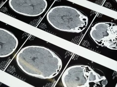 Agresywne glejaki pobudzają neurony, aby przyspieszyć swój wzrost. Naukowcy opisali mechanizm