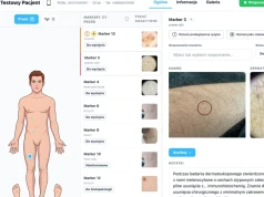 Smartfon pomoże ocenić niepokojącą zmianę na skórze? Polski projekt w światowej czołówce