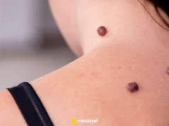 Masz małe narośla na szyi i pod pachami? Mogą być sygnałem cukrzycy