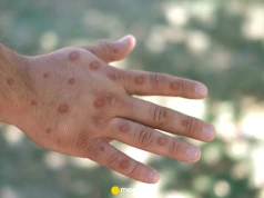 Wzrost zakażeń małpią ospą o 140 procent. GIS apeluje o ostrożność