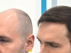 Przeszczep włosów FUE i DHI bez limitu graftów? FullFace Clinic proponuje nowy model