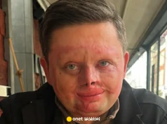 "Ratujcie Artura". Polak mierzy się ze skutkami tragicznego wypadku