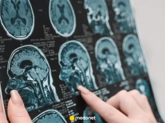 Choroba Alzheimera może zaczynać się poza mózgiem. Problem "leży" też w węzłach chłonnych