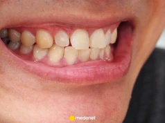 Jakie są domowe sposoby na żółte zęby? To radzi dentystka